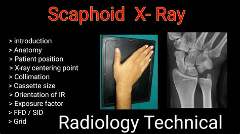 Scaphoid Bone Pa View Wrist Joint Upper Limb Radiography By Bl