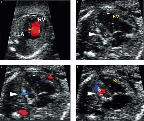 Ultrasound Images Of The Fetal Heart A Color Doppler Image Showing A