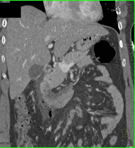 Acute Pancreatitis And Focal Perforation Of Duodenum Following An