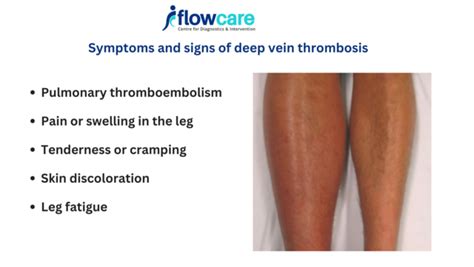Understanding Deep Vein Thrombosis Symptoms Flowcare Bangalore Click In
