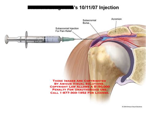 This condition is sometimes called shoulder impingement syndrome and to understand how it occurs it is. AMICUS Illustration of amicus,surgery,injection,rotator,cuff,tear,subacromial,bursa,pain,relief ...