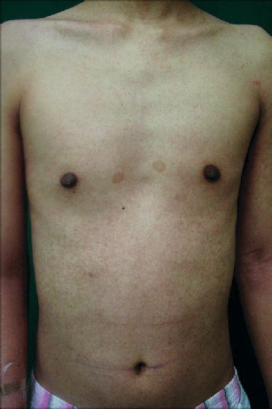 A Photograph Showing Generalized Maculopapular Skin Eruptions Affecting