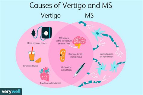 Vertigo In Ms Symptoms Causes Diagnosis And Treatment
