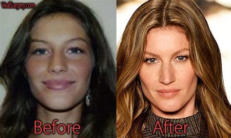 Gisele Bundchen Plastic Surgery Before And After Nose Job Pictures