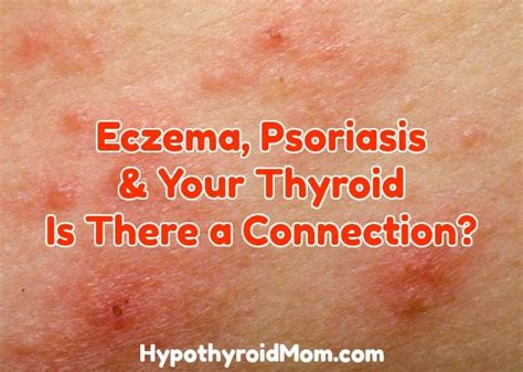 Eczema Psoriasis Your Thyroid Is There A Connection Hypothyroid Mom