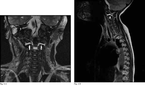Figure 9 From Fractures Of The Bilateral C2 Neurocentral And Lateral