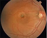 Images of Ocular Histoplasmosis Treatment With Avastin