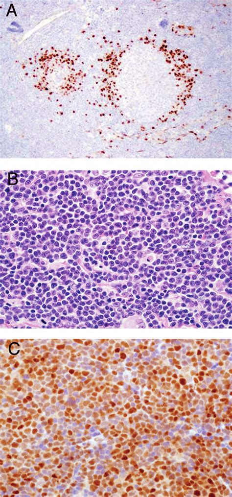 Mantle Cell Lymphoma Mcl In Situ And Sox11 Expression A A Case Of
