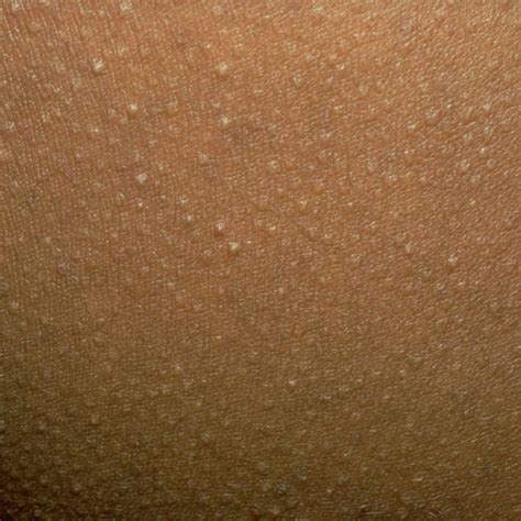 If You See One Of These 13 Bumps On Your Skin Do Not Pop Keratosis