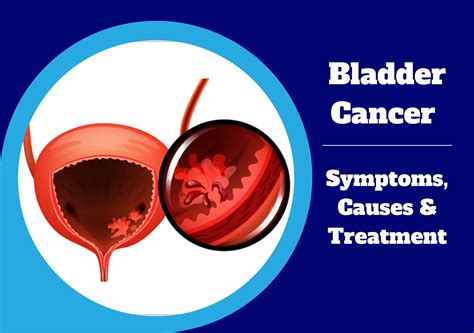 Bladder Cancer Symptoms Causes Treatment UroLife Clinic