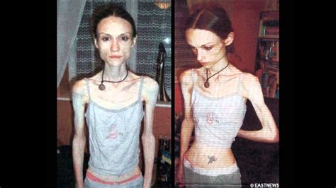 Anorexia Y Obesidad Youtube