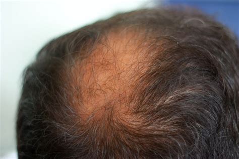 Hair Loss Symptoms Causes And Cures Hair Loss Geeks