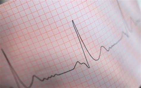Radiation Might Help Heart Regain Its Rhythm Scientific American