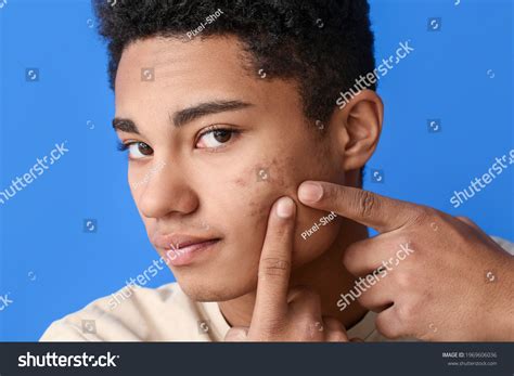 3492 Teenager Boy Acne Images Stock Photos And Vectors Shutterstock