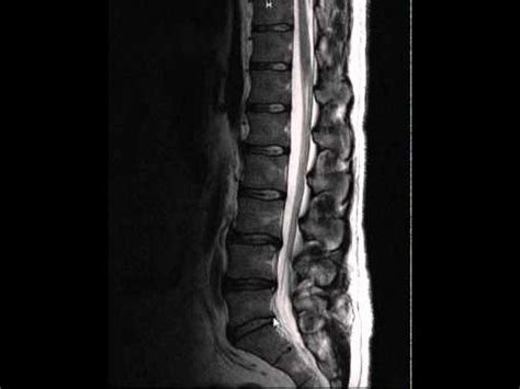 Spinal Arthritis This Is What It Looks Like YouTube