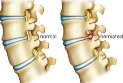 However, surgeons cannot guarantee that symptoms will disappear after surgery. Herniated Disc Treatment in India at Low Cost Cervical Surgery Centres