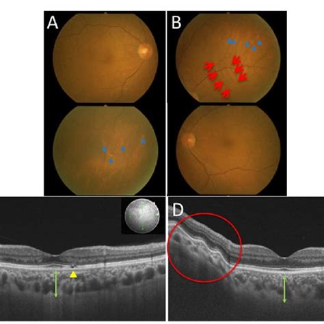 Initial Findings On Color Fundus Photography Cfp And Swept Source