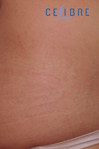 Before And After Stretch Mark Removal On Side 10