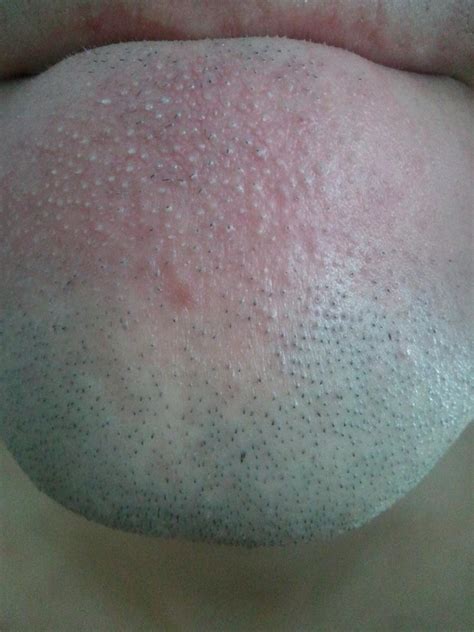 Need Help With Massive White Bumps On My Chin Pic General Acne