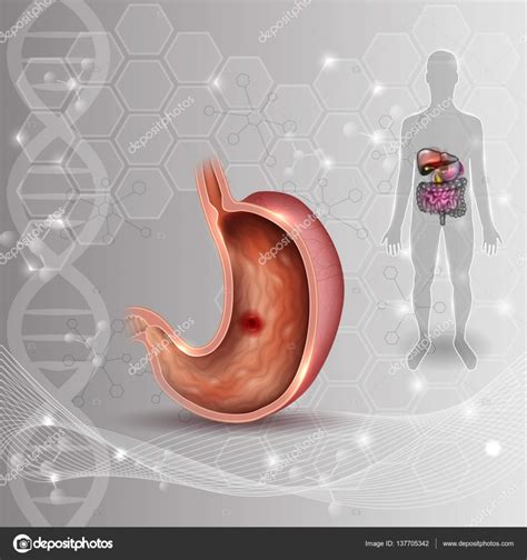 Ulcera Allo Stomaco Anatomia Degli Organi Interni Disegno Colorato