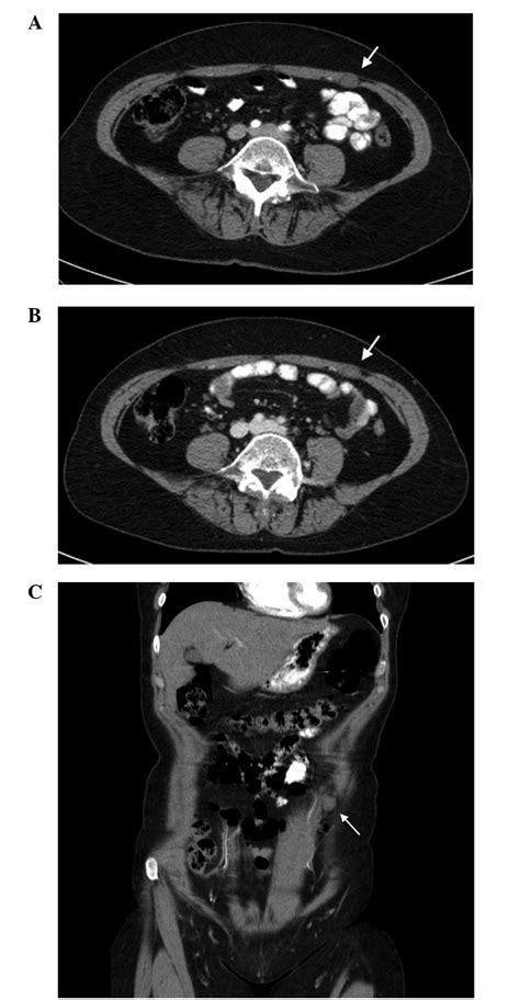 Symptomatic Schwannoma Of The Abdominal Wall A Case Report And Review My XXX Hot Girl