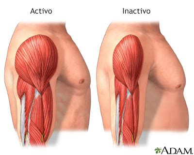 Atrofia Muscular Vektörler Atrofia Muscular Vektör