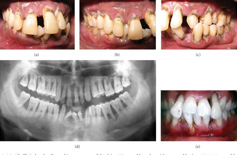 Figure 2 From Generalized Aggressive Periodontitis And Its Treatment