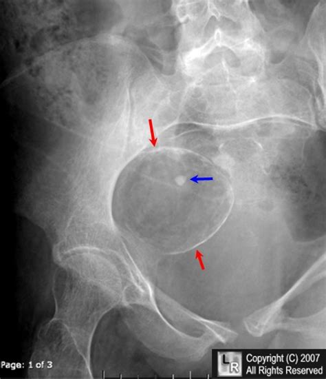 Learning Radiology Dermoid Cyst Ovary Teratoma Rupture Tooth