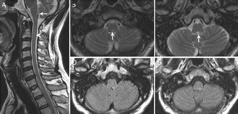 Initial Magnetic Resonance Imaging Mri Of The Brain And Spinal Cord 1