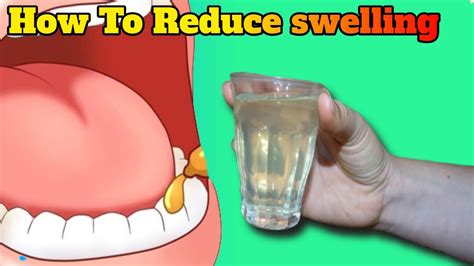 How To Reduce Swelling Of Gums Wisdom Tooth With Home Remedies Youtube