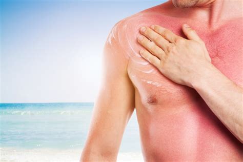 how to prevent and treat a sunburn