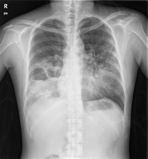 Chest Radiography On Admission Showing A Cavitary Lesion With Air Fluid