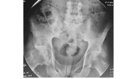 Plain Radiography Of The Hips Bilateral Sacroiliitis Grade Iv And
