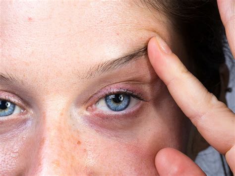 How Do Non Invasive Upper Eyelid Lifting Treatments Work Women S Health Bulletin