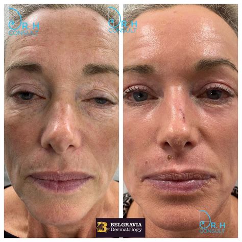 Fully Ablative Co2 Laser Resurfacing Treatment Dr H Consult