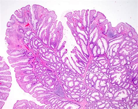 Pathology Outlines Peutz Jeghers Syndrome