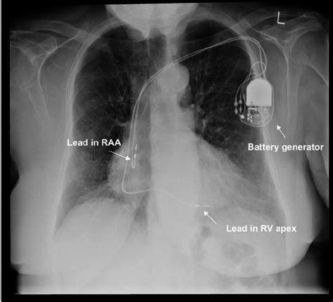 Dual Chamber Pacemaker Seen On Chest Radiograph Raa Right Atrial