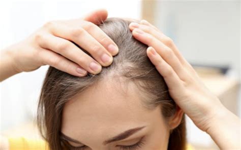Female Pattern Baldness Hair Loss The Bald Company