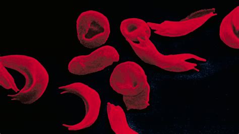 Two New Drugs Help Relieve Sickle Cell Disease But Who Will Pay The
