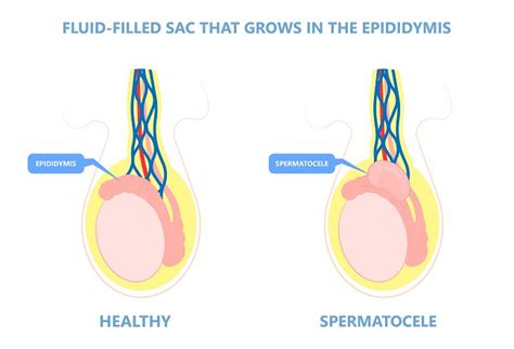 Spermatokel Patofisiologi Diagnosis Penatalaksanaan Alomedika The Best Porn Website