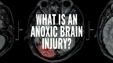 What Is An Anoxic Traumatic Brain Injury I The Mccraw Law Group Youtube