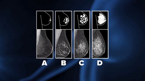 in montana doctors aren t required to tell women they have dense breast tissue a known risk