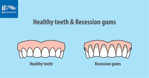 Can Braces Cause Gum Recession Gire Orthodontics Chino Hills La Habra Ca