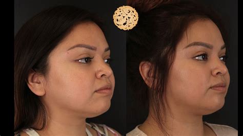 Buccal Fat Removal Before And After Gallery Dr Nazarian