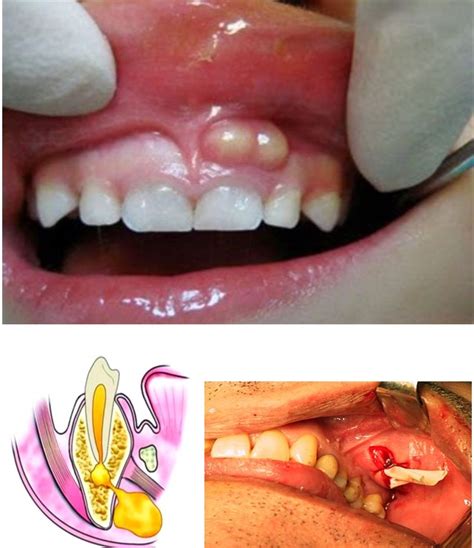OdontologÍa Absceso Dental Equipo De Técnicos Dentales Unidad De