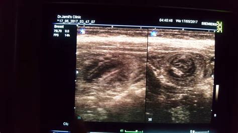 Intussusception Ultrasound Youtube