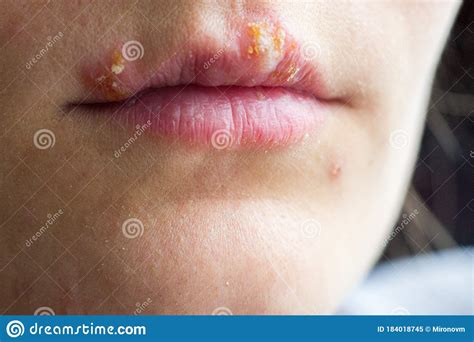 Herpes Disease On The Lips Of A Young Girl Stock Image Image Of