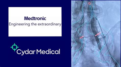 Medtronic Announces First Patient Received Endovascular Treatment In
