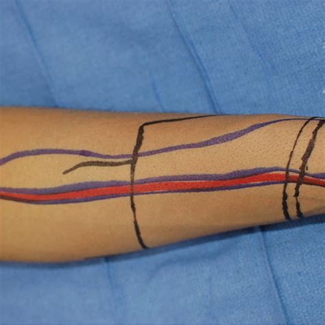 Outline Of The Radial Forearm Free Flap Phalloplasty On The Arm The