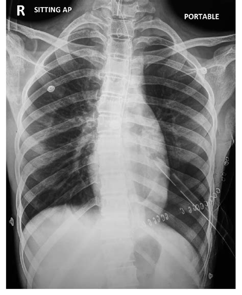 Normal lung x ray, reviews and scores normal lung x ray. Post operative chest X-ray of patient shows good inflation ...